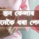 How to Detect Breast Cancer: স্তন কেন্সাৰ কেনেকৈ ধৰা পেলাব